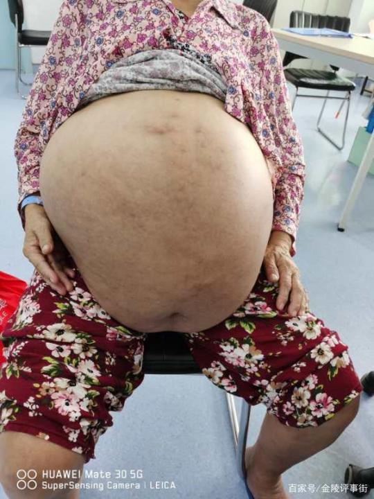 64岁老妇腹大如双胞胎宝宝，原先长了50斤重极大卵巢肿瘤